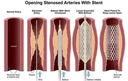 支架再狭窄研究最新进展概述