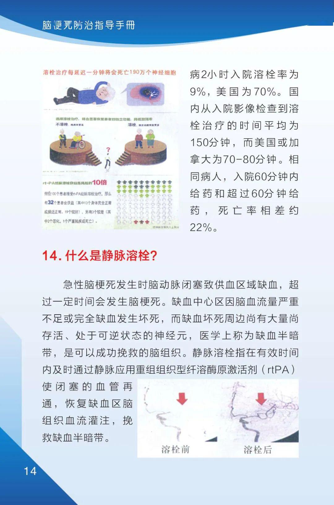 脑梗塞最新治疗指南详解，全面解析最新治疗方法与策略